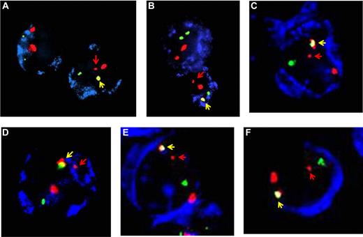 Figure 1. FISH images of cells in newborn cord blood with ETV6-RUNX1 gene fusion. (A) Original image from Mori et al2 (Figure 5C). (B-F) Additional images from other ETV6-RUNX1+ cord blood screened in Mori et al.2 Blue indicates CD19 or CD10; red, RUNX1; green, ETV6; yellow (arrowed), ETV6-RUNX1 fusion; and red arrow, residual (small) RUNX1 signal.