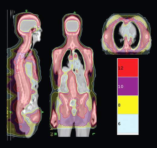 TMLI isodose distribution shows the colorwash isodose distribution of a patient receiving 12 Gy TMLI. Representative sagittal, coronal, and axial planes are displayed. Isodose distributions for 12, 10, 8, and 6 Gy are depicted. See the complete figure in the article beginning on page 309.