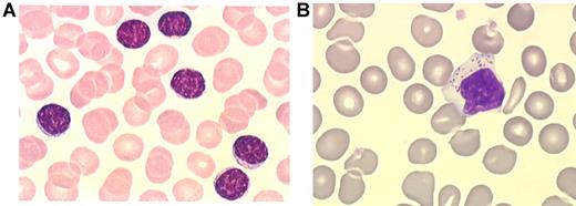 Figure 2. Small and large granular lymphocytes. Distinction between small lymphocytes (A) and large granular lymphocytes (B) on blood smears. Micrographs were viewed with a Leica Leitz DMRB microscope using a 100×/1.30 oil immersion objective. Images were captured with a Sony Exwave HAD camera and manipulated using Tribyn Version 1.3 software.