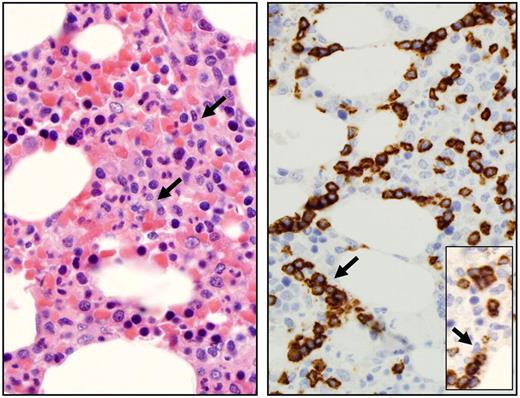 Figure 3. Bone marrow features of T-LGL leukemia. Hematoxylin and eosin staining of marrow biopsy reveals a slightly hypercellular marrow with subtle increase in interstitial lymphocytes, as shown by arrow (left). Immunohistochemistry analyses (right) highlight the presence of intrasinusoidal cytotoxic T-cell infiltrates, staining positive for CD8 (arrow) and granzyme B (inset). Micrographs were viewed with a Leica Leitz DMRB microscope using a 100×/1.30 oil immersion objective. Images were captured with a Sony Exwave HAD camera and manipulated using Tribyn Version 1.3 software.
