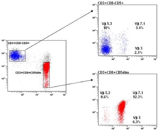 Figure 4. Flow cytometry analysis in LGL leukemia. (A) Blue: Normal nonclonal CD3+ T cells showing a polyclonal Vβ repertoire pattern. Red: LGL population showing a CD3+/CD8+/CD5dim phenotype with a unique clonal Vβ7.1 expression (> 92%). (B) The NK CD3− LGL population strongly expresses the CD94/KIR ag.