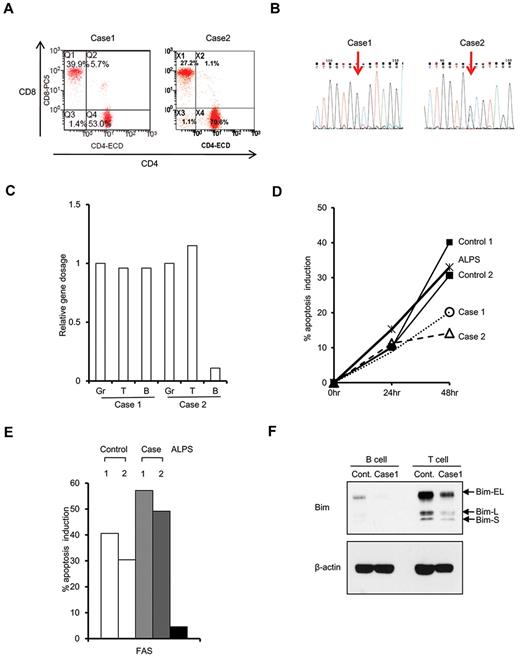 Figure 1. Molecular cell biologic assay of RALD. (A) Flow cytometric analysis of double-negative T cells. CD8 and CD4 double staining was performed in T-cell receptor-αβ-expressing cells. (B) Electropherogram showing KRAS G13D mutation in BM-MNCs in case 1 (left panel) and case 2 (right panel). (C) Gene dosage of mutated allele in granulocytes (Gr), T cells (T), and B cells (B). Relative gene dosage was estimated by a mutant allele-specific polymerase chain reaction method in cases 1 and 2 using albumin gene as internal control. (D) Apoptosis assay using activated T cells. Apoptosis percentage was measured by flow cytometry with annexin V staining 24 and 48 hours after IL-2 depletion. (E) Apoptosis percentage was measured 24 hours after addition of anti-FAS CH11 antibody (final 100 ng/mL). (F) Western blotting analysis of Bim expression.