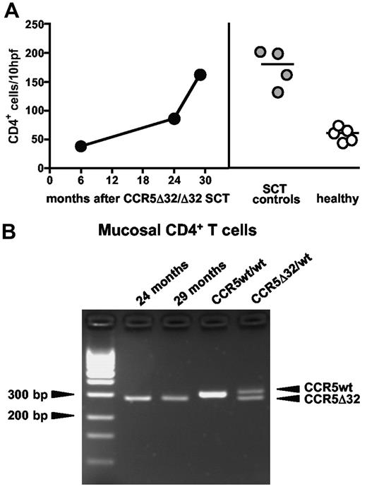 Figure 2. The mucosal immune system has been efficiently repopulated with donor-derived CD4+ T cells. (A) Immunohistochemical quantification of CD4+ T cells in colon tissue of the CCR5Δ32/Δ32 SCT patient, SCT control patients (27 ± 9 months after transplantation), and healthy control patients. The horizontal lines denote the median values of each group. (B) Genomic DNA was extracted from mucosal CD4+ T cells and subjected to CCR5-specific PCR spanning the Δ32 region.
