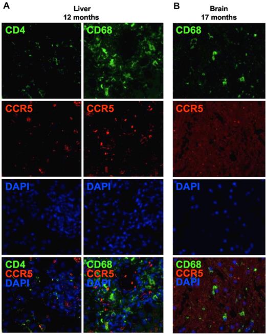 Figure 5. No evidence for residual HIV target cells of host origin in the liver and the brain. CCR5-expressing CD4+ T cells or macrophages were detected (A) in liver and (B) in brain tissue sections obtained 12 and 17 months after CCR5Δ32/Δ32 SCT, respectively, by in situ immunofluorescence double staining for CD4 (green) or CD68 (green) and CCR5 (red). Original magnification ×400. Images were acquired by use of the AxioImager Z1 fluorescence microscope (Carl Zeiss MicroImaging) coupled to the AxioCam MRm digital camera (Carl Zeiss). Acquisition software: Axiovision (Carl Zeiss). Software used for image processing: Adobe Photoshop CS (Adobe Systems).