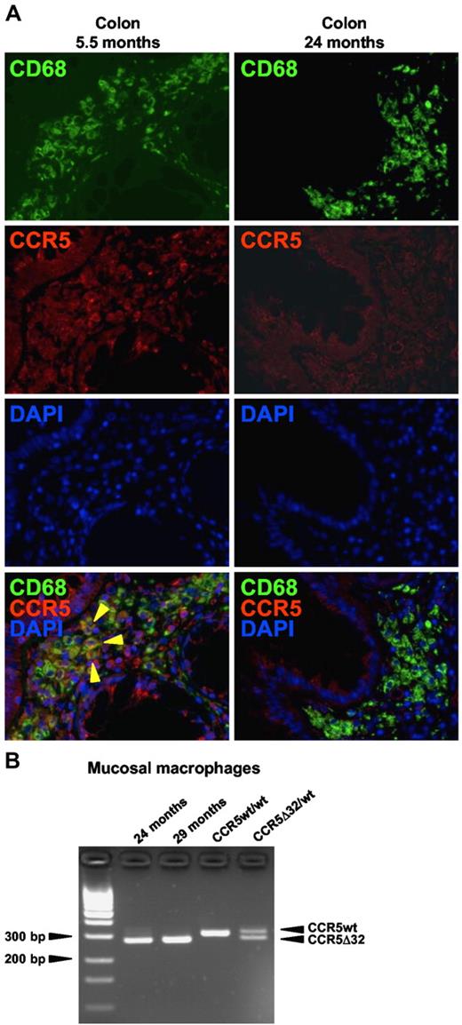 Figure 6. Host macrophages were replaced with donor-derived cells during the course of immune reconstitution. (A) CCR5-expressing macrophages were detected by in situ immunofluorescence double staining for CD68 (green) and CCR5 (red) in colon tissue sections obtained 5.5 or 24 months after CCR5Δ32/Δ32 SCT. CCR5-expressing macrophages are indicated by yellow arrows. (B) At 24 and 29 months after CCR5Δ32/Δ32 SCT, macrophages were sorted from mucosal cells and genotyped by CCR5 variant-specific PCR.