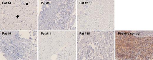 Figure 4. CD123 staining in patients with ECD. ECD anti–CD123 immunostaining is negative in 5 cases (patients no. 6, 7, 9, 14, and 15); in 1 case (patient no. 4) rare cells are positive for CD123 (filled arrowheads). Samples were obtained from blocks containing infiltrated pericardium (patient no. 4), perirenal fat (patients no. 6, 7, and 9), peritoneum (patient no. 14), and aorta (patient no. 15). A cutaneous blastic pDC tumor sample was used as positive control (immunoperoxidase method, magnification ×200).