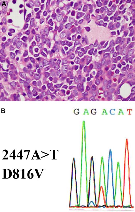 Figure 1. Bone marrow section showing acute myeloid leukemia with a c-KIT D816V mutation. (A) The hematoxylin and eosin–stained bone marrow biopsy shows replacement by blasts with prominent nucleoli and eosinophilic cytoplasm (shown at ×400 magnification). (B) c-KIT D816V mutation detected in bone marrow. DNA was extracted from bone marrow and exon 17 of c-KIT was amplified by polymerase chain reaction (PCR). The PCR product was purified and analyzed by standard direct DNA sequencing procedures using an Applied Biosystems 3730 DNA Genetic Analyzer. A missense A>T mutation is detected at position 2447, which results in a D816V amino acid change.