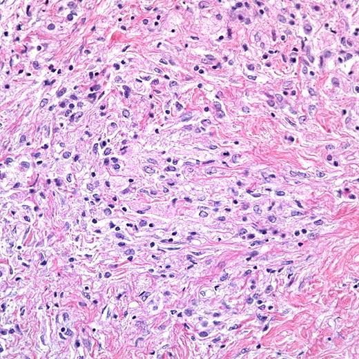 ECD lesion biopsy. (Image and interpretation courtesy of Dr Ronald Jaffe.)