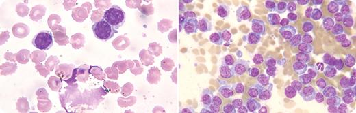 An 85-year-old woman presented with Escherichia coli urosepsis and was treated with antibiotics. While in the hospital, she had persistent leukocytosis (28.2 × 109/L), hemoglobin 92 g/L, and platelets of 238 × 109/L. As seen in the peripheral blood smear (left), the majority of the leukocytes (74%) appeared as lymphocytes. Echinocytes that were present were transient and associated with acute renal failure. A diagnosis of chronic lymphocytic leukemia was considered. However, the peripheral blood findings were new abnormalities, and the patient had no lymphadenopathy or splenomegaly. Flow cytometry of peripheral blood identified these leukocytes as monoclonal plasma cells (CD45 negative, CD38 and CD138 positive, dim CD20, partial CD19 positive, expressing κ light chains) consistent with plasma cell leukemia. / Further work-up revealed hypogammaglobulinemia and the presence of free κ light chains in the serum. A bone marrow examination (right) revealed 75% monoclonal plasma cells that were identical immunophenotypically to the peripheral cells. Treatment with melphalan, prednisone, and bortezomib resulted in a normalization of leukocyte count after the first cycle. / This illustrates an interesting phenomenon wherein circulating plasma cells mimicked small mature lymphocytes and caused a challenge in the diagnosis until clinical findings were correlated with flow cytometry.