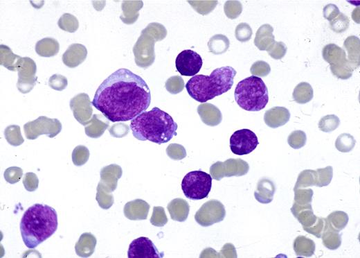 Figure 1. May-Grunwald-Giemsa–stained BM smear showing a mixed-cell population of large and small blasts.