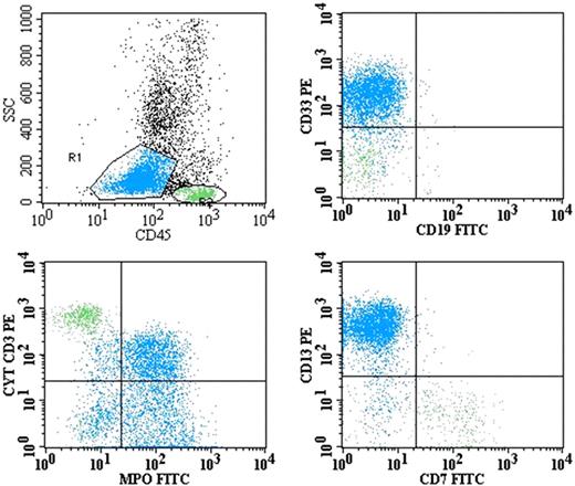 Figure 2. Dot plots with the blast population highlighted in blue (R1) and lymphocyte population in green (R2). These dot plots demonstrate the expression of CD13 and CD33 and coexpression of MPO with cytCD3. Residual T lymphocytes are positive for cyt.CD3 but MPO-negative. CD19 and CD7 are negative.