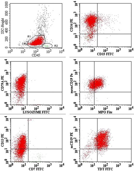 Figure 3. Dot plots with the blast population highlighted in red (R1) and lymphocyte population in green (R2). These dot plots demonstrate the expression of CD13 and coexpression of MPO with CD19. Other positive markers are CD34, CD79a, and TdT. CD7, CD15, and lysozyme are negative