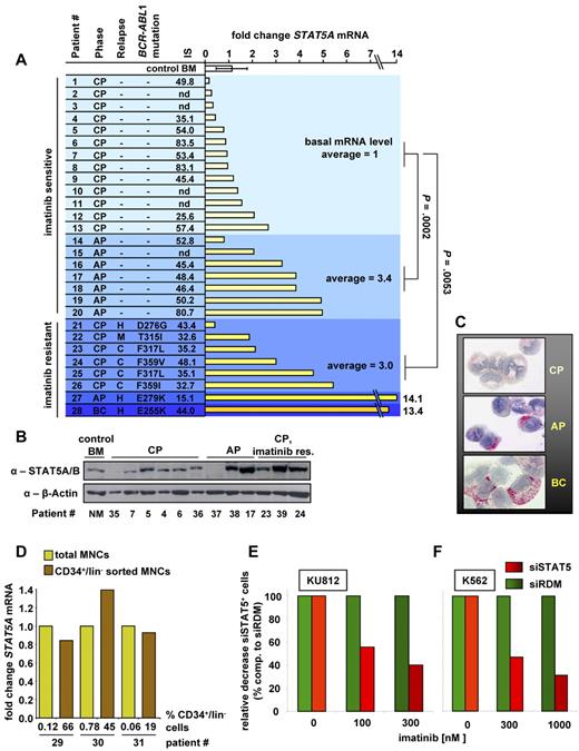 Figure 7. Elevated STAT5 levels are found in advanced CML phases, and STAT5 down-regulation increases imatinib response of human CML cell lines. (A) RT-PCR of human STAT5A mRNA transcripts of BM derived from healthy control patients (n = 3), PB derived from untreated CML patients in CP (n = 13), AP (n = 7), and relapsed imatinib-resistant patients (n = 6 for CP, one in AP, and one in BC). CML phase, kind of relapse (C indicates cytogenetic; H, hematologic; and M, molecular), BCR-ABL1 mutations, IS value for BCR-ABL1 mRNA level, and fold change STAT5A mRNA levels compared with mean STAT5A mRNA level of imatinib-sensitive CP samples are indicated. nd indicates not determined. Each bar represents data derived from an individual patient. Results were normalized by comparison with their GAPDH mRNA expression. P values for patients in imatinib-sensitive CP compared with imatinib-sensitive AP and imatinib-resistant CP are indicated. (B) STAT5A/B immunoblot of BM derived from a healthy patient (control BM) and PB derived from CML diseased patients in CP (n = 6), AP (n = 3), and imatinib-resistant CP (n = 3). Each lane represents an individual patient. (C) Expression of pSTAT5 in primary CML cells. Mononuclear BM cells from 3 CML patients, one in CP (top image), one in AP (middle image), and one in BC (C, bottom image), were spun on cytospin slides and stained with anti-pSTAT5 antibody AX1. Subsets of CML cells in AP and BC were found to stain positive for pSTAT5, whereas fewer cells expressed pSTAT5 in CP. Representative examples are shown. (D) RT-PCR for STAT5A mRNA from total MNCs and CD34+/lin− sorted MNCs derived from 3 individual CML patient samples. (E) KU812 and (F) K562 cells expressing siSTAT5 or siRDM were treated 48 hours with imatinib. Shown is the relative decrease of siSTAT5+ compared with siRDM+ cells. Percentages of siRDM expressing cells served as baseline and were set to 100%.