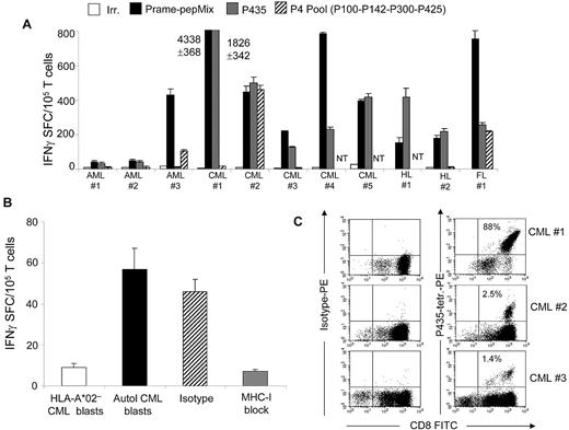 Figure 7. P435/NLT–specific CTLs can be generated from HLA-A*02+ patients. (A) Frequency of IFNγ+ CTLs specific for irrelevant (white bars), PRAME PepMix (black bars), P435 (gray bars) and P4 (striped bars) against specific peptides in 11 HLA-A*02+ patients with AML, CML, HL, or follicular lymphoma. NT indicates not tested. (B) PRAME-CTLs produced IFNγ+ SFCs in response to autologous CML blasts but not against HLA-A*02− CML blasts, and this effect was HLA restricted because IFNγ+ SFCs were reduced when samples were preincubated with an anti–HLA class I antibody, but not with an isotype control. (C) Staining with the P435/NLT–specific tetramer of CTL lines generated from 3 representative patients.