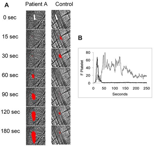 Figure 1. Effect of IgG isolated from antiphospholipid syndrome patient sera on thrombus formation in the mouse laser injury model. Fab fragments of a rat monoclonal anti–mouse CD41 antibody conjugated to Alexa 647 (0.3 μg/g body weight) and either normal IgG (1 mg) or patient A IgG (1 mg) were infused into a wild-type mice 5 minutes before laser-induced arteriolar wall injury. (A) Representative images of the fluorescence signal associated with platelets (red) over 180 seconds after vessel injury are shown within the context of the bright-field histology. (B) The median integrated platelet fluorescence (F Platelet) associated with platelet thrombus formation in 3 wild-type mice after infusion of patient IgG (n = 25 thrombi) or control IgG (n = 25 thrombi) over 250 seconds after vessel wall injury. Gray represents patient A IgG; and black, control IgG.