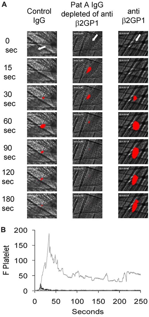 Figure 2. Effect of purified anti–β2-GP1 autoantibodies on thrombus size. Autoantibodies reactive with anti–β2-GP1 were isolated from the purified IgG of patient serum. Anti–β2-GP1-depleted IgG is the IgG from a patient that does not bind to the β2-GP1-agarose column. (A) Anti–β2-GP1 autoantibodies from patient A (10 μg), anti–β2-GP1-depleted IgG from patient A (1 mg), and control normal serum IgG (1 mg) were infused into wild-type mice 5 minutes before laser-induced arteriolar wall injury in addition to Fab fragments of rat monoclonal anti–mouse CD41 antibody conjugated to Alexa 647. Representative images of the fluorescence signal associated with platelets (red) over 180 seconds after vessel injury are shown within the context of the bright-field histology. (B) The median integrated platelet fluorescence (F Platelet) associated with platelet thrombus formation in 3 mice after infusion of anti–β2-GP1 autoantibody (n = 25 thrombi), 3 mice after infusion of IgG depleted of anti–β2-GP1 autoantibodies (n = 36 thrombi), and 4 mice after infusion of control IgG (n = 34 thrombi) is presented over 250 seconds after vessel wall injury. Light gray represents anti–β2-GP1 autoantibodies; gray; IgG-depleted of anti–β2-GP1 autoantibodies; and black, control IgG.