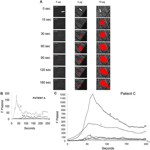 Figure 3. Amplification of thrombus size as a function of the quantity of anti–β2-GP1 autoantibody infusion. Anti–β2-GP1 autoantibodies from patient A or patient C at various doses were infused into wild-type mice 5 minutes before laser-induced arteriolar wall injury. Fab fragments of rat monoclonal anti–mouse CD41 antibody conjugated to Alexa 647 or rat monoclonal anti–mouse CD42 antibody conjugated to Dylight 649 were also infused to allow fluorescence detection of the platelet thrombus. (A) Representative images of the fluorescence signal associated with platelets (red) within the context of the bright-field histology are presented after vessel injury in mice treated with anti–β2-GP1 autoantibodies from patient A. (B) The median integrated platelet fluorescence (F Platelet) as a function of time in 3 separate mice after infusion of 0 μg (n = 22 thrombi), 3 μg (n = 25 thrombi), or 10 μg (n = 25) of anti–β2-GP1 autoantibodies derived from patient A. (C) The median integrated platelet fluorescence (F Platelet) as a function of time in 3 separate mice after infusion of 0 μg (n = 25 thrombi), 1.5 μg (n = 30 thrombi), 3 μg (n = 28 thrombi), 6 μg (n = 29 thrombi), 10 μg (n = 29 thrombi), and 65 μg (n = 24 thrombi) of anti–β2-GP1 autoantibodies derived from patient C. a indicates 0 μg; b, 1.5 μg; c, 3 μg; d, 6 μg; e, 7 μg; f, 10 μg; and g, 65 μg.