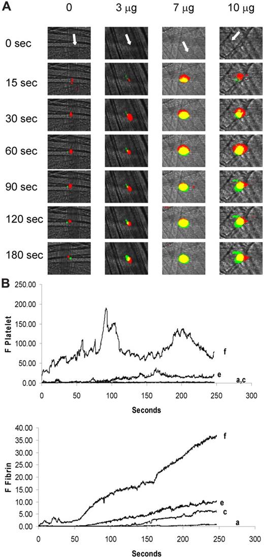 Figure 4. Amplification of fibrin generation and platelet thrombus accumulation as a function of the quantity of anti–β2-GP1 autoantibody infusion. Anti–β2-GP1 autoantibodies from patient B at various doses were infused into wild-type mice 5-15 minutes before laser-induced arteriolar wall injury. Fab fragments of rat monoclonal anti–mouse CD42 antibody conjugated to Dylight 649 and mouse anti–human fibrin monoclonal antibodies labeled with Alexa 488 were also infused to allow fluorescence detection of the platelet thrombus and fibrin. (A) Representative images of the fluorescence signal associated with platelets (red) and fibrin (green) over 180 seconds after vessel injury are for mice treated with anti–β2-GP1 autoantibodies from patient B. Yellow represents merge. (B) The median integrated platelet fluorescence (F Platelet; top panel) and the median integrated fibrin fluorescence (F Fibrin; bottom panel) as a function of time in 3 to 5 mice after infusion of 0 μg (n = 25 thrombi), 3 μg (n = 23 thrombi), 7 μg (n = 19), or 10 μg (n = 24) of anti–β2-GP1 autoantibodies derived from patient B. a indicates 0 μg; c, 3 μg; e, 7 μg; and f, 10 μg.