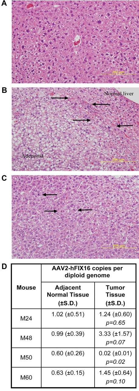 Figure 1. HCC tissue differs histopathologically from normal and adenomatous liver tissue but has no difference in vector genome copy number. Hematoxylin and eosin–stained sections for histopathologic diagnosis of (A) normal liver; (B) hepatic adenoma, arrows denote zone of compression between adenoma and normal liver; and (C) hepatocellular carcinoma, arrows indicate mitotic figures. Images were captured with the use of a Zeiss Axiophot microscope (Carl Zeiss Imaging, Inc) with a 20×, 0.40 aperture EC PLAN NEOFLUAR objective lens at room temperature. Images were acquired with the use of an Olympus DP70 (Olympus America Inc) camera and DP Manager Version 1.21.107 software, with subsequent image cropping performed with Adobe Photoshop. (D) AAV2-hFIX16 vector genome copy number in tumor and normal liver was quantified by qPCR, performing 3 independent measurements on total DNA isolated from tumor and normal liver tissue. P values from 2-tailed Student t test between 3 independent measurements of adjacent normal liver tissue and tumor tissue.