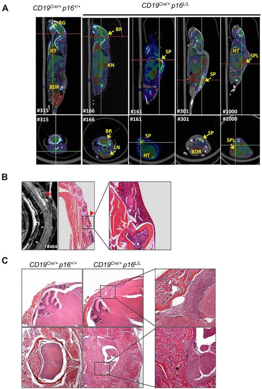 Figure 7. B-lineage p16INK4a deletion is associated with high-grade B-cell neoplasms. (A) Representative fused PET/CT images of aged CD19Cre/+ p16+/+ and CD19Cre/+ p16L/L mice identifying tumors with high 18F-FDG uptake in brain (BR), spine (SP), spleen (SPL), and lymph nodes (LN). Background uptakes were observed in heart (HT), bladder (BDR), kidney (KN), and retro-orbital gland (RG). (Top) Sagittal images with red lines indicating level of the associated transverse images (bottom). (B) A T2-weighted MRI of a representative CD19Cre/+ p16L/L mouse indicates a lesion in the spinal cord, which was confirmed by histopathologic analysis to represent lymphoma invading spinal cord from bone marrow. Original magnification ×20. (C) Hematoxylin and eosin–stained images of CNS lymphomas in the brain (top) or spinal cord (bottom) of aged CD19Cre/+ p16L/L mice. Comparison images from littermate CD19Cre/+ p16+/+ mice are shown (left). Original magnification ×40.