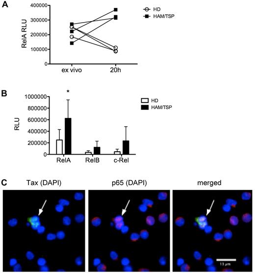 Figure 1. PBMCs from subjects with HAM/TSP demonstrate increased NF-κB activation in association with viral protein expression. NF-κB activation was measured by an NF-κB DNA-binding ELISA (TransAM NF-κB transcription factor ELISA; Active Motif) on nuclear extracts from PBMCs of subjects with HAM/TSP and healthy donors to detect nuclear translocation of NF-κB subunits. (A) Nuclear RelA (p65) levels in PBMCs from subjects with HAM/TSP compared with healthy donors (HD), measured directly ex vivo and after 20 hours (20h) of culture. RLU, relative LIGHT units. (B) RelA, RelB, and c-Rel levels in nuclear extracts from healthy donor (HD) PBMCs (n = 6) compared with HAM/TSP PBMCs (n = 6). *P < .05, unpaired t test. (C) Immunofluorescence analysis of PBMCs from a subject with HAM/TSP showing HTLV-I Tax protein expression (left; Alexa Fluor 488), RelA expression (center; Alexa Fluor 594), and merged image (right), with DAPI nuclear counterstain. One representative image from 2 subjects is shown. Note the nuclear translocation of RelA in cells expressing Tax (arrow) compared with the intracytoplasmic sequestration of RelA in cells not expressing Tax. Observation was performed with a Zeiss Axiovert 200M equipped with mercury lamp house HBO-100 and appropriate filters for detecting DAPI and the 2 secondary antibodies conjugated to Alexa Fluor 488 and Alexa Fluor 594, using a 63× oil objective.