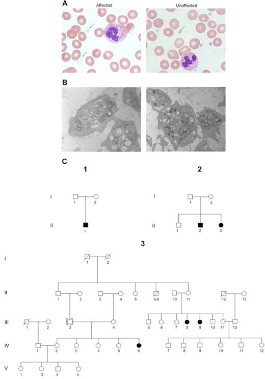 Figure 1. GPS characterization and pedigrees. (A) Wright-Giemsa staining of blood smears demonstrates the large size and gray appearance of platelets in the affected person (left panel arrow) compared with her unaffected mother (right panel arrow). (B) Electron microscopy demonstrates the lack of α-granules in a platelet from the same person with GPS (left panel) compared with her mother (right panel). (C) Pedigrees for the 3 families that were analyzed in this study. Families 2 and 3 are Native American from a single settlement. Person 1 from family 1 is of Pakistani origin.
