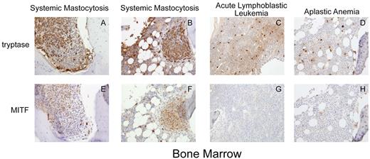 Figure 1. Trypase and MITF are coexpressed in systemic mastocytosis. Immunohistochemistry for tryptase and MITF was performed on bone marrow specimens from patients with systemic mastocytosis and other hematologic diseases. (A-D) Cytoplasmic tryptase staining in bone marrow mast cells in 2 patients with systemic mastocytosis and the D816V KIT mutation (A-B), aplastic anemia (C), and acute lymphoblastic leukemia (D). (E-F) Nuclear MITF staining in mast cells in systemic mastocytosis. Mast cells in aplastic anemia and acute lymphoblastic leukemia (G-H) do not express significant MITF. Mast cells in systemic mastocytosis are spindle shaped and grow in clusters, whereas mast cells in other conditions do not. Photomicrograph images were acquired at room temperature with a Kontron ProgRes 3012 digital camera and Roche Image analysis software with a Zeiss Axiophot microscope (original magnification ×20). Images cropped with Photoshop Elements 2.0 (Adobe).