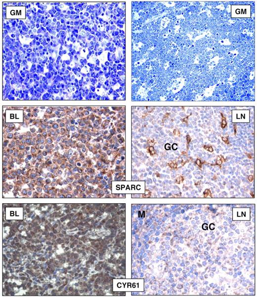 Figure 7. Immunohistochemical analysis on tissue microarrays. Cases were considered as positive when > 30% cells were stained (Olympus BX41 microscope equipped with an Olympus UPlanFI × 40/075 or 20/050 numerical aperture objectives and Olympus CAMEDIA C-7070 camera; Olympus Italia Srl; magnification ×400; colors balanced after acquisition with Adobe Photoshop). BLs mainly consisted of neoplastic elements with typical morphology in the majority of cases (GIEMSA; GM). SPARC and CYR61 stainings are shown in BL and reactive lymph nodes (LNs). In both instances, nonneoplastic B cells were mostly negative, with scattered CYR61 positivities in GC and mantle (M) zones.