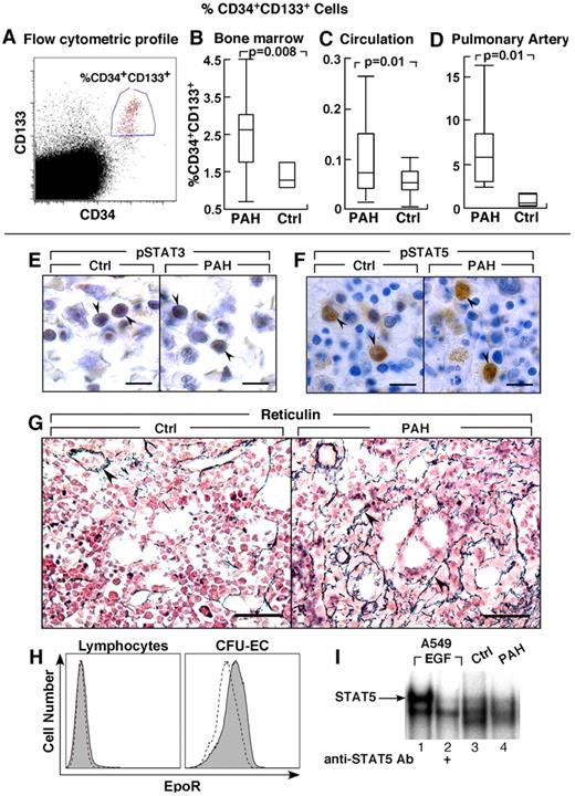 Figure 1. Greater CD34+CD133+ progenitors in PAH. (A-D) CD34+CD133+ progenitors in PAH determined by flow cytometry. Box plots indicate median values, upper and lower quartiles. There are increased hemangioblasts in PAH bone marrow, and higher levels of CD34+CD133+ progenitors in circulation and within the pulmonary artery endothelium than in controls. (E-F) STAT3 and STAT5 activation and localization in bone marrow biopsies. Cellular localization of phosphoSTAT3 (pSTAT3) by immunohistochemical staining in bone marrow biopsy (arrowheads) from PAH patient and healthy control (E). Immunohistochemical staining for phosphoSTAT5 (pSTAT5) in bone marrow biopsy (arrowheads) from PAH patient and healthy control (F). (G) Reticulin increase in bone marrow of PAH patients. Reticulin staining as a measure of myelofibrosis, was increased in PAH bone marrows. Arrowheads identify reticulin staining in bone marrow biopsies from PAH subject. The reticulin stain around a blood vessel is normally present, and is shown as internal positive in the control tissue. (H) EpoR expression by flow cytometry. Dashed lined histogram indicates background staining with isotype control antibodies, solid histogram indicates EpoR staining. CFU-EC have low levels of EpoR, while lymphocytes are shown as negative control have no EpoR. (I) STAT5 activation in CFU-EC. Electrophoretic mobility shift assay for STAT5 DNA binding activation in whole cell extract of CFU-EC from PAH patient (lane 4) and healthy control (lane 3) is shown. STAT5 DNA-binding activation is similar among PAH and control CFU-EC. A549 cells stimulated with Epidermal Growth Factor (EGF) is a positive control, and the supershift using antibody to STAT5 identifies the STAT5-DNA complex (arrow). Scale bars: 6 μm (E); 10 μm (F); 40 μm (G).