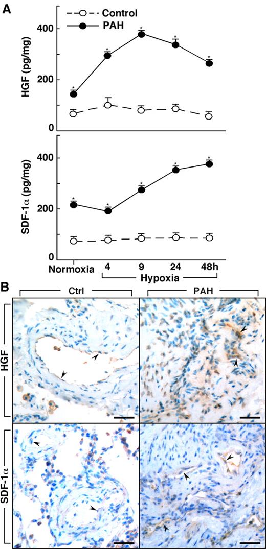 Figure 3. Increased production of HGF and SDF-1α by primary human pulmonary arterial endothelial cells (PAECs) from PAH. (A) HGF and SDF-1α is secreted by PAH PAEC in culture at higher levels than by control cells under both normoxia and hypoxia conditions (*all P < .05). HGF secretion by PAH PAEC was significantly increased on exposure to hypoxia (ANOVA P = .0001). SDF-1α levels also significantly increased with hypoxia in both PAH (ANOVA P = .0001) and control PAEC (ANOVA P = .0007). (B) HGF and SDF-1α in lung tissues from controls and PAH patients. Endothelial cells in plexiform lesions of PAH lungs had strong positive immunoreactivity for HGF (arrowheads identify endothelial cells lining vascular lumens). Endothelial cells of control lung expressed HGF, but immunopositivity was much less prominent (arrowheads). SDF-1α expression was present in endothelial cells of plexiform lesions in PAH lung (arrowheads). Only mild immunopositivity for SDF-1α was found in vessel endothelium of control lung (arrowheads). Scale bars: 40 μm.