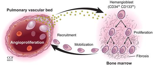 Figure 5. Pulmonary vascular disease and myeloid abnormalities in PAH. This study identifies hemangioblast proliferation and fibrosis as key components in the pathophysiology of PAH. Increased levels of HIF-inducible factors, some of which are produced by diseased pulmonary vascular cells, promote hemangioblast proliferation and progenitor cell mobilization. Local production of recruitment factors by pulmonary vascular endothelium attract mobilized progenitor cells into the pulmonary artery wall where these cells fuel vascular remodeling. (Illustration by David Schumick, BS, CMI. Reprinted with permission, Cleveland Clinic Center for Medical Art & Photography, 2010. All rights reserved.)
