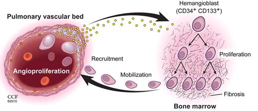 Patients with PAH display increased circulating levels of HIF-inducible factors, some produced by pulmonary endothelial cells, that promote hematopoietic stem/progenitor cell proliferation in a bone marrow microenvironment predisposed to myeloproliferation and fibrosis. Local production of HIF-inducible factors by the pulmonary arterial endothelial cells recruit the mobilized hematopoietic subsets into the vessels leading to inappropriate vascular remodeling that eventually obliterates vascular perfusion through the pulmonary arterioles. Copyright 2010. Cleveland Clinic. All rights reserved. See the complete figure by Farha et al on page 3485.