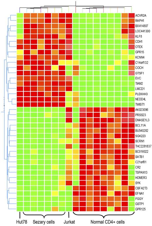 Figure 2. Genes with expression aberration specific to Sézary cells. Expression change of 32 genes are specific to primary Sézary cells and Sézary cell line Hut78, compared with normal CD4+ T cells and non-SS T-cell leukemia cell line Jurkat cells. Hierarchichal unsupervised clustering of those genes classify primary Sézary cells and Hut78 cells from normal controls, and from Jurkat cells. Among those genes, 16 are overexpressed in Sézary cells, whereas 16 are underexpressed in Sézary cells.