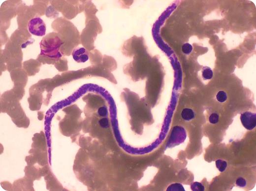 A 60-year-old man from an area endemic for leishmaniasis presented with 2 months of fever and hepatosplenomegaly. He had normal complete blood counts and negative blood and urine cultures. Chest x-ray revealed miliary shadows in both lung fields. A transbronchial lung biopsy showed granulomata with tubercle bacilli. / A bone marrow biopsy, performed as part of an assessment for fever, was normocellular with normal hematopoietic cell lines. However, while screening the marrow for Leishman-Donovan bodies, a few microfilariae were seen (shown). These were identified as Wuchereria bancrofti by the presence of a hyaline sheath, elongated terminal nuclei, length of cephalic space, and the pointed posterior end without terminal or subterminal swellings. On wet mount preparation, the filamentous translucent organisms exhibited brisk motility. Scanty microfilariae were seen on reviewing the blood film. Treatment for tuberculosis and filariasis was initiated. / Tropical pulmonary eosinophilia is usually characterized by cough, fever, and hepatosplenomegaly with an absence of circulating microfilariae, but marked eosinophilia. In this case, the microfilariae in the blood and an absence of peripheral eosinophilia were consistent with asymptomatic microfilaremia. The patient had no history of lymphangitis, hydrocele, or limb swelling. The hepatosplenomegaly and fever might have been caused by concomitant tuberculosis. / India is one of many countries endemic for filariasis. The World Health Organization has recommended the use of mass drug administration (annual dose of diethylcarbamazine with albendazole) to those living in endemic areas in an effort to eliminate the infection.