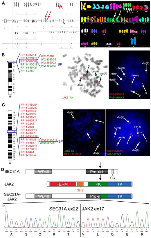 Figure 1. Cytogenetic and molecular analysis of the t(4;9)(q21;p24) found in case 1. (A) Conventional (left) and M-FISH karyotype (right). Note 2 copies of the t(4;9)(q21;p24) in both karyotypes (red and white arrows) and 1 additional copy of the der(4) in the M-FISH karyotype (white arrows). (B) An ideogram of chromosome 9 with probes used for the FISH characterization of the t(4;9) (left) and examples of FISH experiments (right). BAC probes included in the dual color JAK2 break-apart (JAK2 BA) assay are shown in the middle figure, fosmid probes covering JAK2 are shown in the right figure. Split of JAK2 BA signals on der(4) and der(9) (metaphase cell) illustrates the t(4;9)-associated rearrangement of JAK2. Further analysis with fosmid probes covering JAK2 mapped the breakpoint in the region flanked by WI2-2850C2 and WI2-1990K3 (split of red and green fosmid signal in an interphase cell). (C) An ideogram of chromosome 4 with probes used for the FISH characterization of the 4q21 breakpoint in the t(4;9) (left) and examples of FISH experiments (right). The 4q21 breakpoint was mapped with a BAC/fosmid walking interphase FISH strategy. The telomeric (5′) JAK2 probes (labeled with SpectrumGreen-dUTP) marking the der(4) were combined with particular 4q21 probes (labeled with SpectrumOrange-dUTP). The colocalized red and green signals (metaphase cell) indicate that the analyzed 4q21 probe hybridized with the der(4), while separated signals indicate that the probe is translocated to the der(9). Using this strategy, we narrowed down the 4q21 breakpoint to the region flanked by RP11-164M11 and RP11-93E17 that harbors SEC31A. Fosmid probes flanking the SEC31A gene (WI2-2194A15 and WI2-2877K7) were used to prove rearrangement of this gene (interphase cell; separated red and green signals). (D) Schematic representation of the SEC31A, JAK2 and SEC31A-JAK2 protein structures (top panel). Sequencing of the fragment amplified by SEC31A-JAK2 nested RT-PCR identified an in-frame fusion between exon 22 of SEC31A and exon 17 of JAK2 as shown in the electropherogram (bottom panel). FISH probes were directly labeled with SpectrumOrange- and SpectrumGreen-dUTP (Abbott Molecular). FISH images were acquired with a 63×/1.40 oil-immersion objective in an Axioplan 2 fluorescence microscope equipped with an Axiophot 2 camera (Carl Zeiss Microscopy) and a MetaSystems Isis imaging system (MetaSystems).