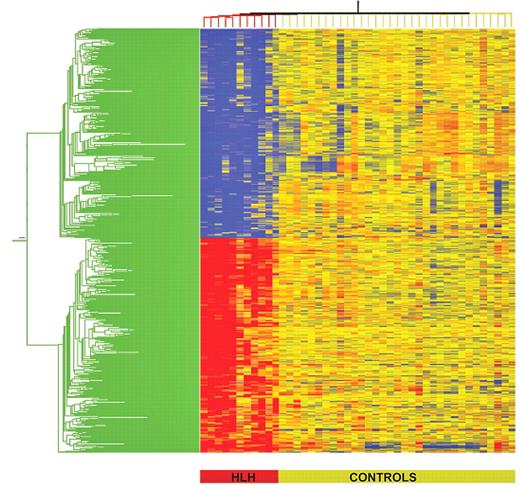 Figure 2. Hierarchical clustering of differentially expressed genes in FHL versus controls. Differentially regulated genes were identified using analysis of variance (false discovery rate 5%) followed by Tukey post-hoc testing. Individual patients are oriented in columns and expression level for each gene oriented in rows. Red, yellow, and blue colors represent expression levels that are greater than, equal to, or less than the mean expression levels, respectively, in all samples. The color-coded bar at the bottom of the heat-map represents controls in yellow and patients (P59, P33, P59 P1002, P101, P76, P92, P94, P98, P66, and P96) in red.