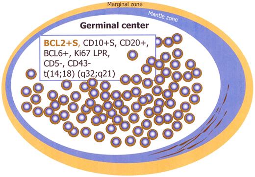 Figure 1. Immunophenotype of intrafollicular neoplasia/“in situ” FL (box). Schematic figure. S indicates strong; and LPR, low proliferation rate.