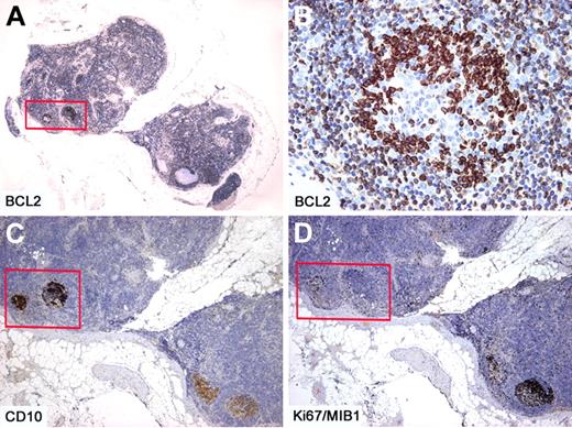Figure 2. Intrafollicular neoplasia/“in situ” follicular lymphoma. Within 2 affected follicles (box), the BCL2+ (A-B) and CD10+ (C) cells are confined only to the GCs. Within the same affected follicles, the proliferation rate as assessed by Ki67/MIB1 is lower than that observed in reactive follicles (box) (D). Immunoperoxidase, hematoxylin counterstain. Images were taken using a Nikon Eclipse 80i microscope (Nikon) with Plan UW 2×/0.06 (A), Plan Fluor 20×/0.50 (B), Pan Fluor 4×/0.13 (C-D) objectives and Nikon digital sight DS-Fi1 camera equipped with control unit-DS-L2 (Nikon). Images were assembled using Adobe Photoshop 6 (Adobe Systems).