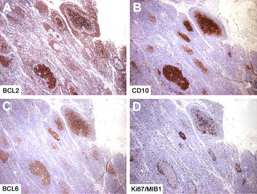 Figure 3. Intrafollicular neoplasia/“in situ” follicular lymphoma. In another case with several affected follicles, the number of BCL2+ cells is variable, whereas the BCL2 staining is consistently high and uniform (A). The proliferation is limited to the follicular areas, as demonstrated by CD10 (B) and BCL6 (C) and the proliferation rate is low (D). Immunoperoxidase, hematoxylin counterstain. Images were taken using a Nikon Eclipse 80i microscope (Nikon) with a Pan Fluor 4×/0.13 objective and Nikon digital sight DS-Fi1 camera equipped with control unit-DS-L2 (Nikon). Images were assembled using Adobe Photoshop 6 (Adobe Systems).