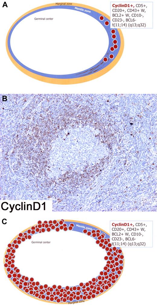 Figure 4. Schematic figure of “in situ” mantle cell lymphoma (MCL) and early involvement of overt MCL; immunophenotype in the box. (A) Schematic figure of “in situ” MCL in which lymphoma cells are restricted to the inner zone of the mantle, pattern A (“in situ” MCL). (B) Lymphoma involvement is limited to the mantle zone of a secondary follicle with minimal expansion of this structure. Only a fraction of mantle cells expresses Cyclin D1, pattern B (“in situ” MCL?). (C) Schematic figure of early involvement of overt MCL showing that the lymphoma cells completely involve the expanded mantle zone of the follicle, pattern C (overt MCL). Immunoperoxidase, hematoxylin counterstain. (B) Images were taken using a Nikon Eclipse 80i microscope (Nikon) with a Plan Fluor 20×/0.50 objective and Nikon digital sight DS-Fi1 camera equipped with control unit-DS-L2 (Nikon). Images were assembled using Adobe Photoshop 6 (Adobe Systems).