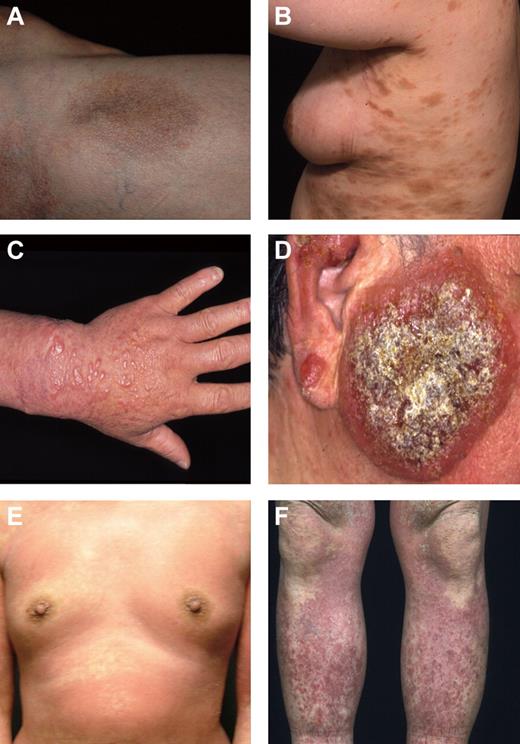 Figure 1. Clinical features of ATLL with skin eruptions. (A) Patch type, (B) plaque type, (C) multipapular type, (D) nodulotumoral type, (E) erythrodermic type, and (F) purpuric type.