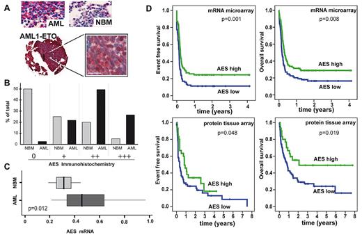 Figure 2. AES expression in AML patients and its association with patient prognosis. (A) Representative micrographs of TMA from NBM and AML patients stained with anti-AES antibody and Fast-Red secondary antibody contrasted with hematoxylin and eosin. Overview and 63× magnification of one sample with the t(8; 21) (AML1/ETO) chromosomal translocation. Bar represents 20 μm. (B) Quantitative TMA analysis of AES expression using categories of staining intensity (0 indicates nothing; + low; ++ moderate; and +++ strong) shows comparison between NBM specimens (N = 40; AML, N = 163) in percentage of total number of samples. Statistical significance using χ2 test was P less than .05. (C) RT-PCR analysis of AML patients (n = 50) versus NBM (n = 8) of AES mRNA level demonstrates higher AES expression levels in AML (P = .012). (D) Kaplan-Meier plots of event-free survival and overall survival in AML patients with low or high levels of AES expression. For mRNA analyses, a published microarray dataset was used, and patients were regarded as high or low on AES expression based on the median expression. Immunohistochemistry was performed by tissue array of an independent patient population. In both groups, patients with a favorable karyotype (t(15;17), t(8;21), inv(16)) or C/EBPα mutations were excluded. Statistical significance was evaluated using the log-rank test (Mantel-Cox).