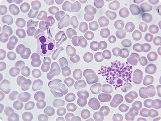 A 57-year-old retired farmer with no personal or family history of bleeding was found to have thrombocytopenia on routine blood work. He had a history of type 2 diabetes, hypertension, hyperlipidemia, and osteoarthritis. Medications included perindopril, insulin glargine, aspirin, metformin, ibuprofen, and oregano oil. Physical examination was normal. / His complete blood count (CBC) revealed a white blood cell count of 9.4 × 109/L, hemoglobin 160 g/L, and platelets of 10 × 109/L by automated counter. A peripheral blood film showed clumping of platelets (shown). A bone marrow aspirate and biopsy, initially performed to rule out myelodysplasia, was normal with normal-appearing megakaryocytes in adequate numbers. The original blood sample used ethylenediaminetetraacetic acid (EDTA) as an anticoagulant. A repeat CBC was done in sodium citrate and the platelet count was normal. The patient was diagnosed with pseudothrombocytopenia and no further treatment or blood work was required. / Unrecognized pseudothrombocytopenia may result in unnecessary diagnostic testing and clinical concern. A microscopic examination can identify platelet clumping and repeat CBC tests using a different anticoagulant can affirm the diagnosis.