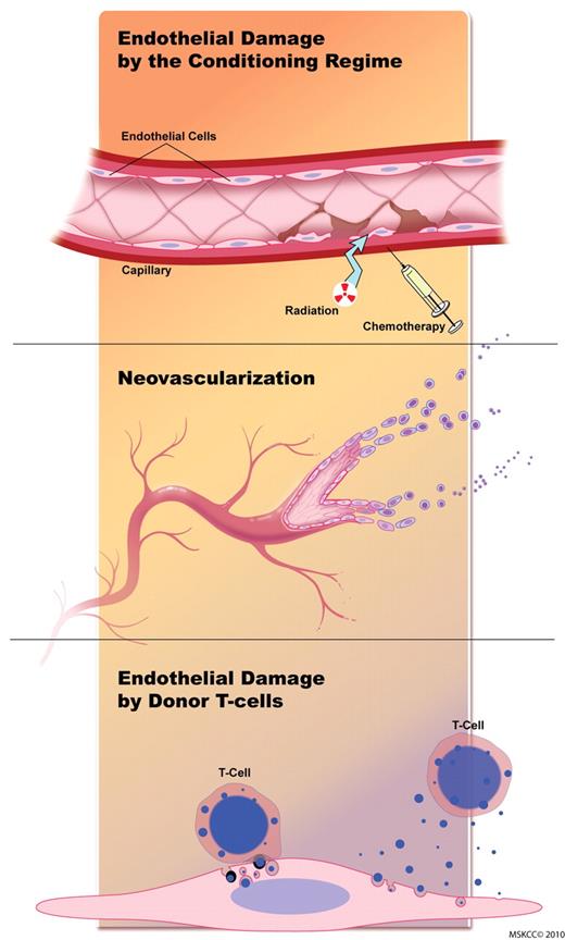 Figure 1. The endothelium is sequentially affected during GVHD. Initial endothelial damage is caused by the conditioning regimen. During the second phase, neovascularization and recruitment of inflammatory cells occur. During the later stages of GVHD, alloreactive T cells target the endothelium, and blood vessels are destroyed. Figure by Terry Helms from Medical Graphics at Memorial Sloan-Kettering Cancer Center.