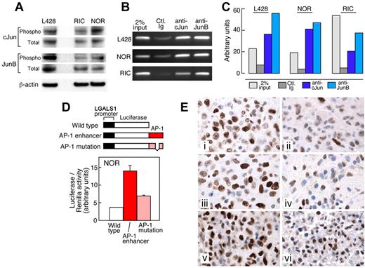 Figure 2. AP-1–dependent Gal1 expression in EBV-transformed LCLs and primary PTLDs. (A) Total phospho-cJun and JunB expression in the cHL cell line L428 and in 2 EBV-transformed LCLs, RIC and NOR. β-Actin was used as a loading control. (B) ChIP-PCR analysis of cJun and JunB binding to LGALS1-enhancer regions in the cHL cell line L428 and in 2 LCLs, NOR and RIC. Results are representative of triplicate experiments. (C) Densitometric analyses of ChIP-PCR data from panel B. (D) LGALS1-promoter- and enhancer-driven luciferase activity in LCLs. NOR cells were cotransfected with 300 ng of the pGL3-Gal1–promoter constructs (without or with the wild-type or mutant AP-1–dependent LGALS1 enhancer) and 100 ng of the control reporter plasmid pRL-TK, and evaluated for relative luciferase activity, as described previously.4 (E) Immunohistochemistry analysis of JunB (i,iii,v) and phospho-cJun (ii,iv,vi) in 3 primary EBV+ PTLDs. The PTLDs had uniformly high nuclear staining of JunB and positive phospho-cJun staining of variable intensity.