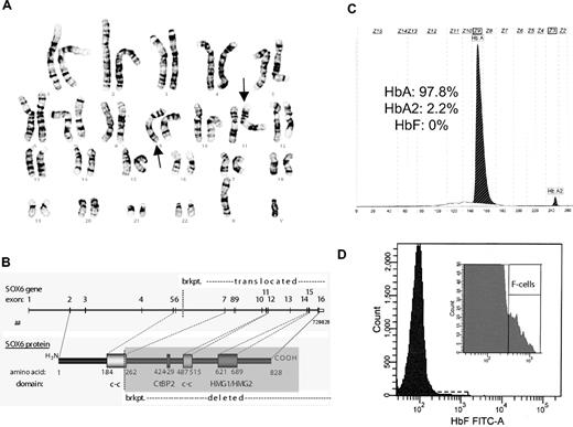 Figure 1. Heterozygous disruption of SOX6 does not result in elevations of HbF levels. (A) Conventional G-banding of chromosomes analyzed from the patients lymphocytes showing a balanced translocation with a karyotype of 46,XY,t(9;11)(q33.1;p15.1) that could be confirmed with fine mapping. (B) A schematic showing the resulting breakpoint (brkpt.) on chromosome 11 at position 16195,423 (from hg18) that disrupts the SOX6 gene. Domains are shown from SOX6, including the coiled-coil (c-c), CtBP2 binding, and HMG domains. (C) HbF content was measured using capillary electrophoresis (Capillarys 2; Sebia). No HbF was detected, which should be detectable in zone 7 (Z7). (D) The number of F cells were quantitated by flow cytometry (BD FACSCanto II; Becton Dickinson). A total of 50 000 erythrocytes were analyzed. The patient had 0.7% F cells (normal range: 0.4%-4%).