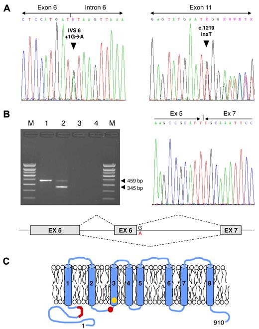 Figure 1. TMEM16F mutations. (A) TMEM16F mutation screening in the Scott patient under study. Identification of the TMEM16F IVS6 + 1G→A (left) and c.1219insT mutations (right) in the patient's genomic DNA. (B) TMEM16F cDNA analysis. (Top left) Amplification of a TMEM16F cDNA amplicon spanning exons 5-8 yielded only the expected 459-bp fragment in the normal control (lane 1), but also a shorter 345-bp fragment in the patient (lane 2). Lane 3, reverse transcription blank; lane 4, PCR blank; M, molecular weight marker. (Top right) Sequencing of the 345-bp fragment showed that it corresponds to TMEM16F mRNA molecules lacking exon 6 (because of the IVS6 + 1G→A mutation). (Bottom) Schematic representation of the splicing aberration (exon 6 skipping) in the patient's TMEM16F pre-mRNA. (C) Schematic representation of the TMEM16F protein. The positions of the previously described TMEM16F mutation2 (IVS12–1G→T, predicting the truncation of the protein in the third transmembrane domain, shown in yellow) and of the mutations identified in this study (IVS6 + 1G→A, predicting the in-frame deletion of 38 amino acids in the N-terminal cytoplasmic tail, and c.1219insT, predicting the truncation of the protein between the second and third transmembrane domains, both shown in red) are indicated.
