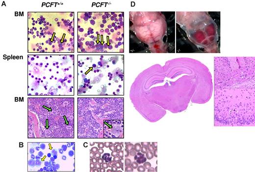 Figure 3. PCFT deficiency leads to impaired erythropoiesis and thrombopoiesis. (A) Representative May-Grünwald-Giemsa-stained cytocentrifuge preparations show accumulation of proerythroblasts and large basophilic erythroblasts (yellow arrows) in 4- to 6-week-old PCFT−/− mice. Periodic acid Schiff-stained BM sections (original magnification 10×/0.3 NA dry objective) contain reduced number of megakaryocytes (green arrows) in PCFT−/− mice than in WTs. (Inset) Megakaryocytes are less differentiated in the PCFT−/− BM, as evidenced by marked reduction in cytoplasmic volume and nuclear lobulation. (B) Abnormal neutrophil precursors (giant metamyelocytes, yellow arrows) in the BM of PCFT−/− mice (May-Grünwald-Giemsa staining of cytocentrifuge preparations). (C) Multilobed polymorphonuclear neutrophils in the PCFT−/− blood smears. (D) Representative picture of submeningeal hemorrhage in a PCFT−/− mouse (top panels) (original magnification 40×/0.75 NA dry objective). No evidence of deep intracerebral hemorrhage and calcification was found in PCFT−/− brain sections by hematoxylin and eosin (bottom panel) and von Kossa staining (not shown). The hematoxylin and eosin low power image (original magnification 2×/0.08 NA dry objective) corresponds to the location of the insets at the right (original magnification 20×/0.75 NA dry objective; sagittal fissure above corpus callosum and ventrolateral cortex, respectively).
