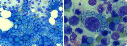 A 61-year-old man had 1 week of fatigue, nausea, weight loss, and hypertension. His creatinine was 1271μM and potassium was 5.6mM. The complete blood count, sedimentation rate, lactate dehydrogenase, calcium, phosphate, and albumin were normal. Tests for ANCA and anti-GBM were negative. His serum immunoglobulin levels were markedly suppressed. Serum electrophoresis showed monoclonal kappa light chains (2690 mg/L) and the urine had a trace of kappa chains. Multiple lytic lesions were also seen. Bone marrow showed monoclonal kappa light chain plasma cells (8% of the nucleated cells) with numerous large, blue spherical depositions, both extracellularly (shown, left) and within plasma cells (shown, right). A kidney biopsy revealed cast nephropathy with spherical deposits of monoclonal kappa chains. / He was begun on bortezomib and dexamethasone and required hemodialysis. After 3 months of no improvement, he was referred for intensive chemotherapy and stem cell transplantation. Interestingly, his father and uncle had multiple myeloma that required acute hemodialysis and chemotherapy. / Plasma cells occasionally contain blue, pink, or colorless cytoplasmic spherules that are known as Russell bodies. These globules can also be seen extracellularly. When large accumulations of spherules appear within a plasma cell, it may be referred to as a Mott cell. These abnormalities are not specific for light chain myeloma and may be seen in other types of myeloma, as well as in chronic inflammation or immunologic stimulation (tuberculosis, rheumatoid arthritis, etc).