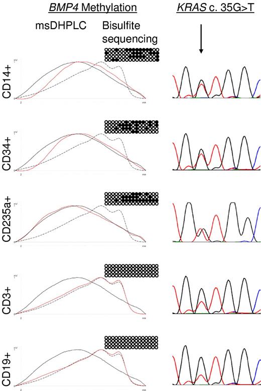 Figure 3. Lineage specificity of aberrant methylation in JMML patient D360. Hypermethylation of the BMP4 CpG island was analyzed by msDHPLC and bisulfite sequencing in flow-sorted CD14+, CD34+, CD235a+, CD3+, and CD19+ spleen cell fractions. On the left are msDHPLC chromatograms in which dotted lines represent healthy control DNA, black lines methylated control DNA, and red lines sample DNA. In the center are the results of bisulfite sequencing in which horizontal lines represent individual alleles (4 per cell sample); ●, methylated cytosines; and ○, unmethylated cytosines. On the right are the results of genomic sequencing; the arrow indicates the position of the heterozygous KRAS c.35 G>T mutation.